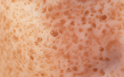 L’hyperpigmentation