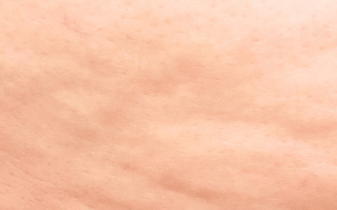 La cellulite