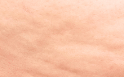 La cellulite