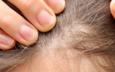 La chute de cheveux