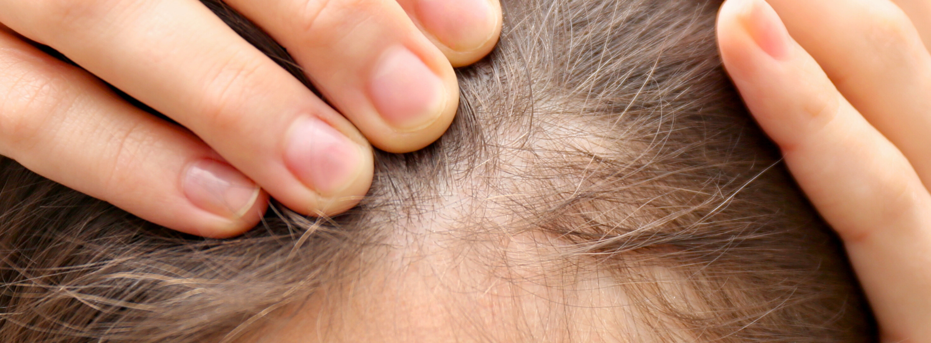 chute de cheveux