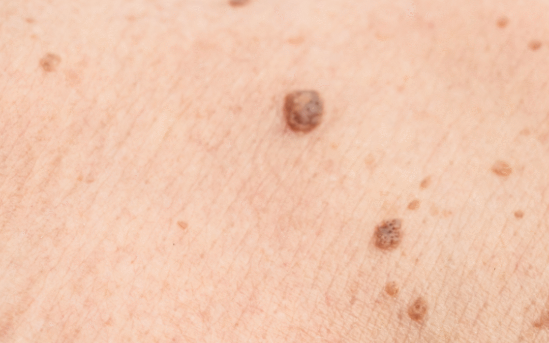 Peau fragilisée post-cancer
