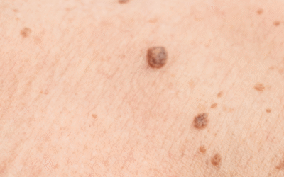 Peau fragilisée post-cancer