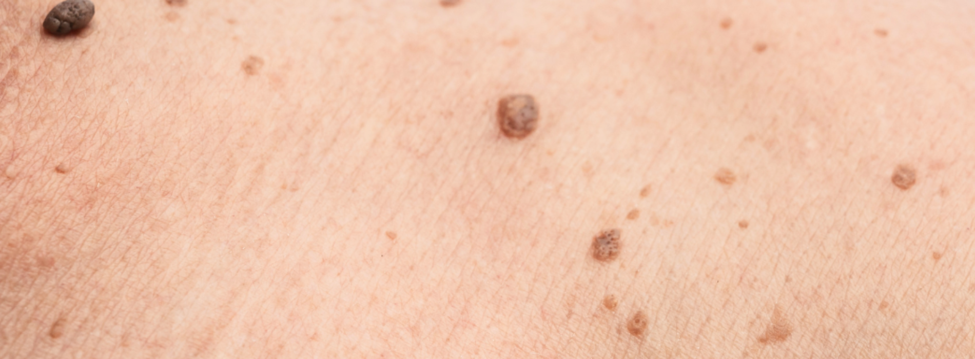 La peau après le traitement d'un cancer