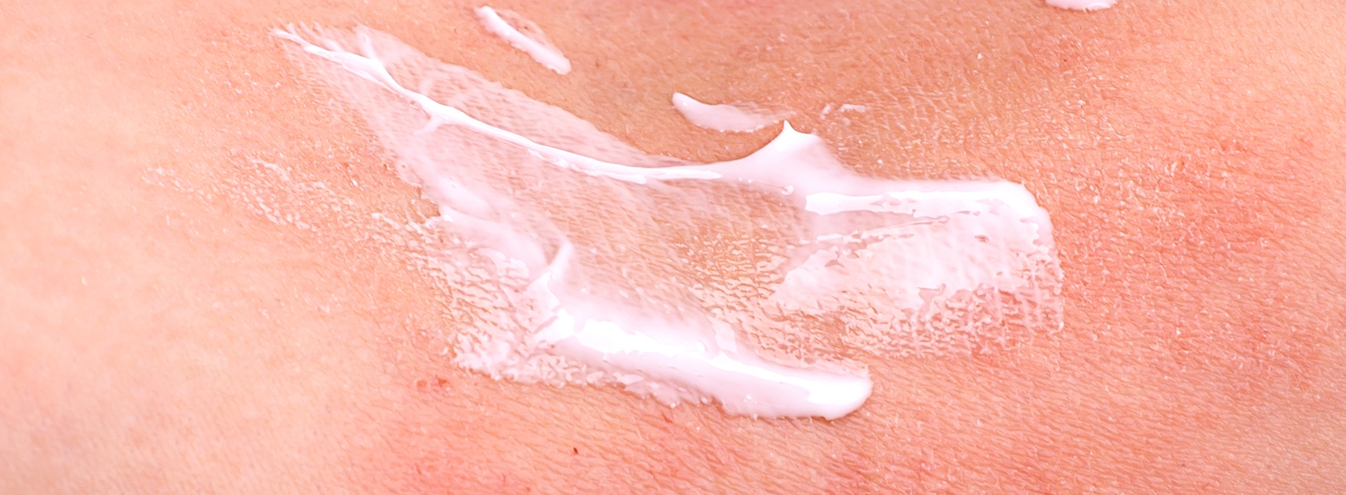 la peau atopique La peau atopique