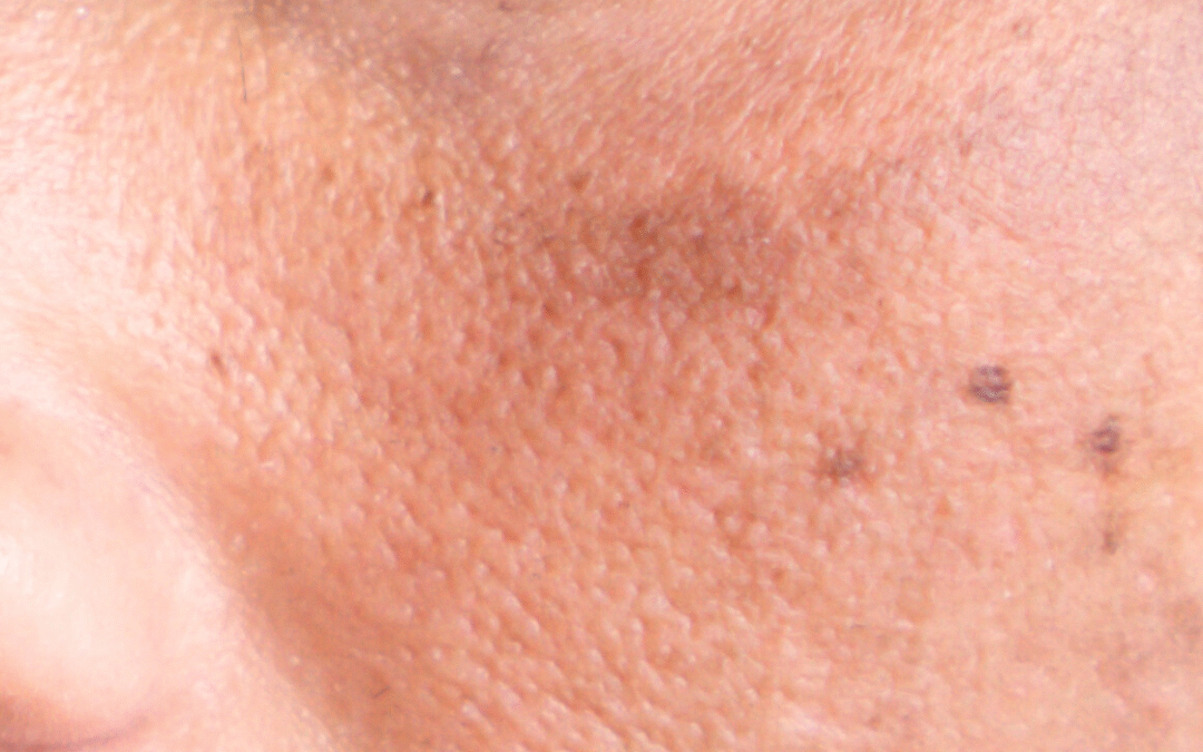 L’hyperpigmentation