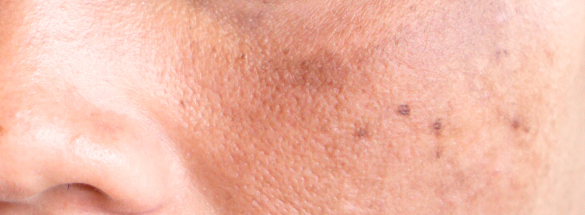 l'hyperpigmentation
